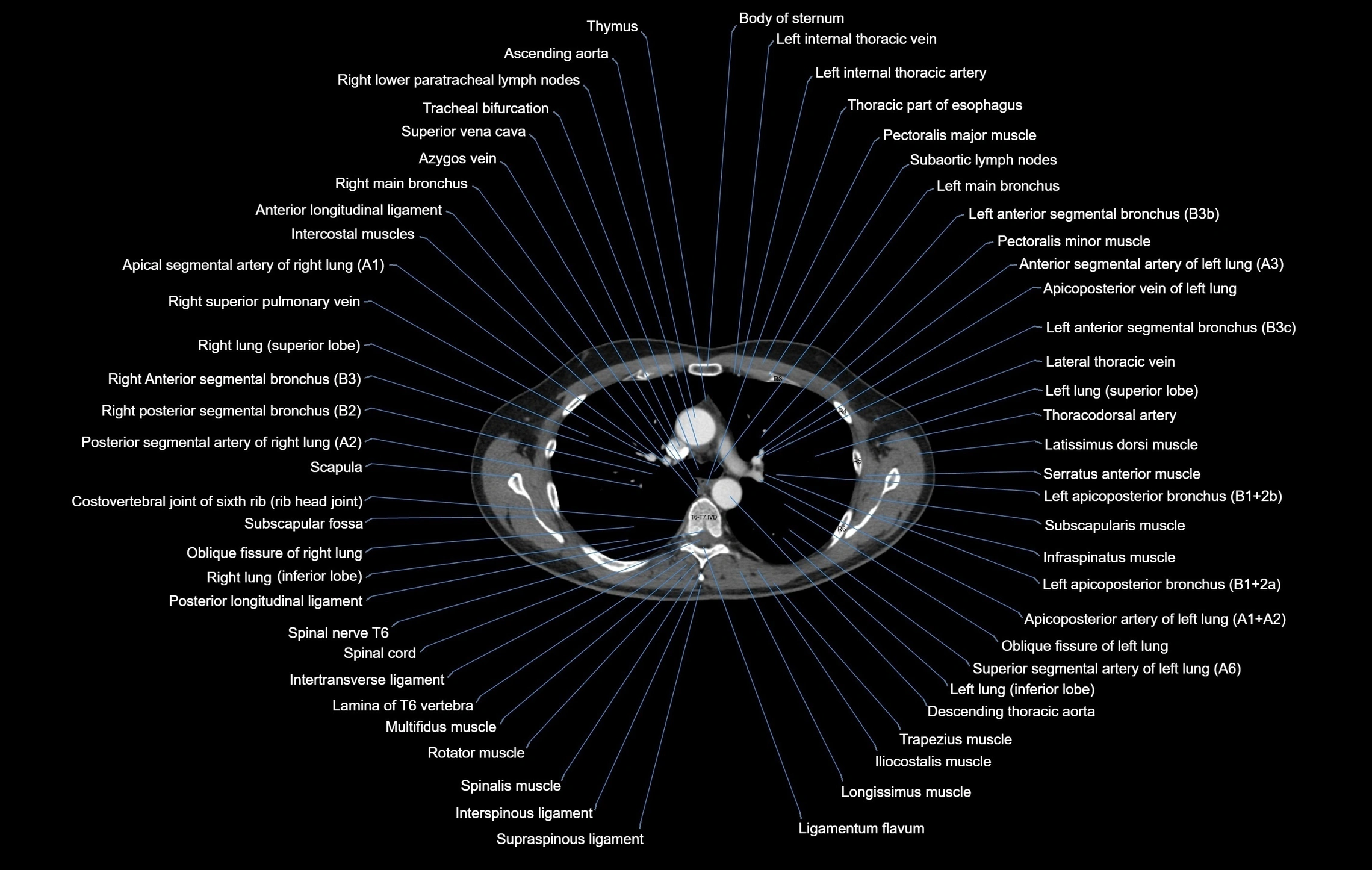 CT chest (thorax) labelled axial cross sectional anatomy radiology image-00048.webp